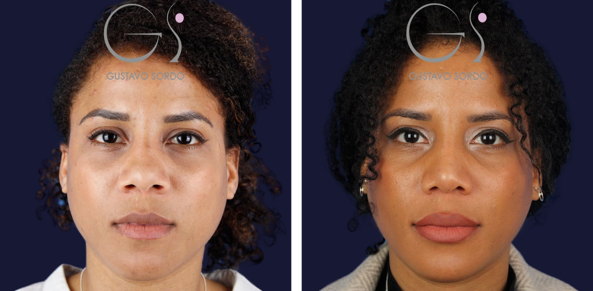 Rinoplastia: antes y después de un caso operado por el Dr. Gustavo Sordo en Madrid