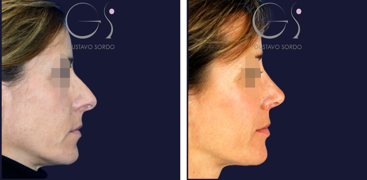 Rinoplastia: antes y después de un caso operado por el Dr. Gustavo Sordo en Madrid