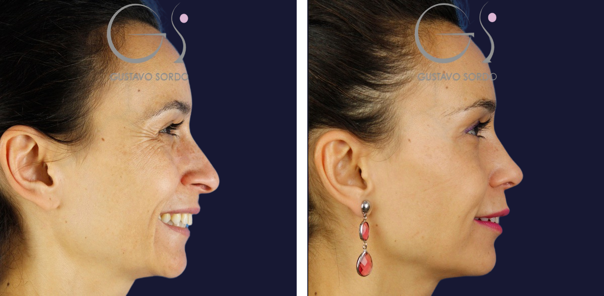 Otro resultado de rinoplastia híbrida, antes y después