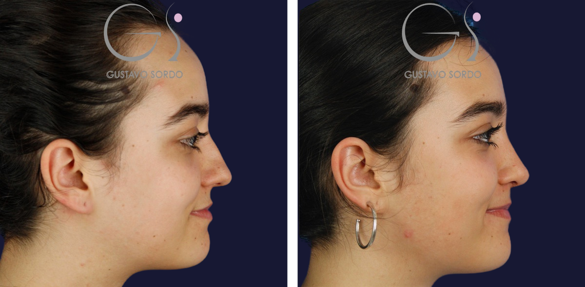 Rinoplastia: antes y después de un caso operado por el Dr. Gustavo Sordo en Madrid