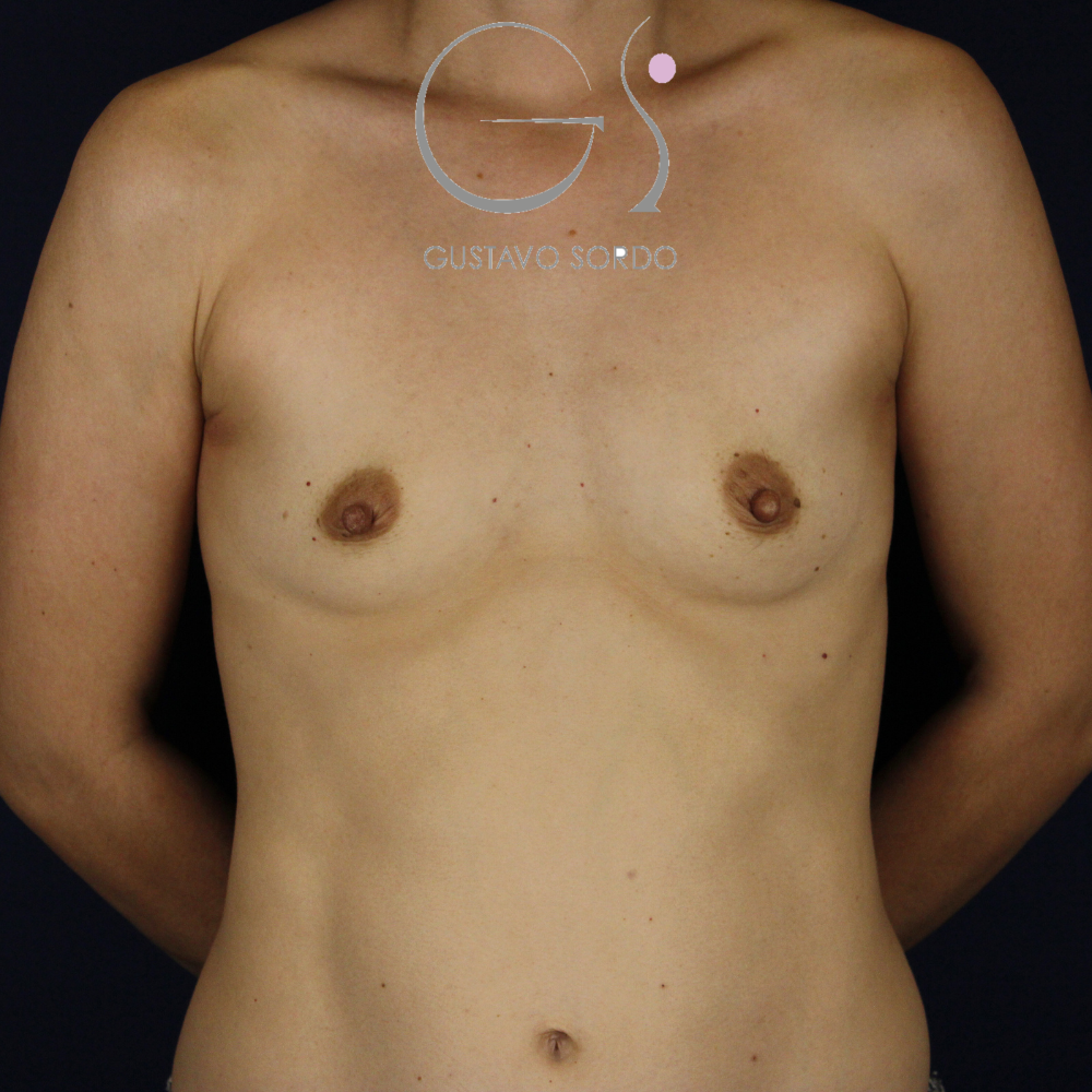 Antes y después de aumento de pecho con resultado natural