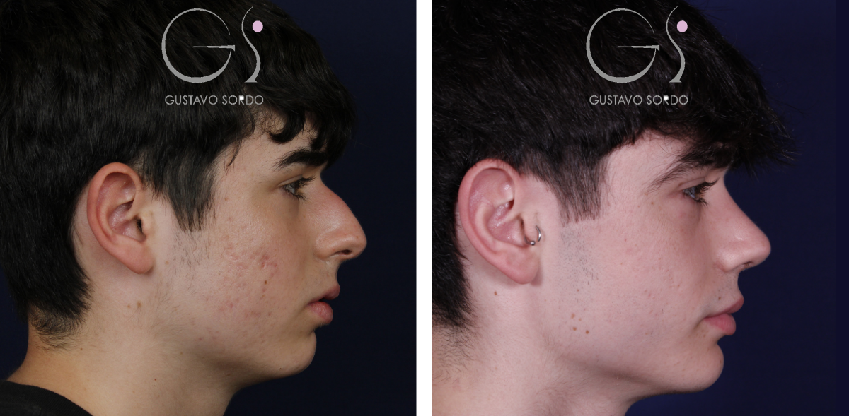 Rinoplastia — en hombre: antes y después de un caso operado en Madrid