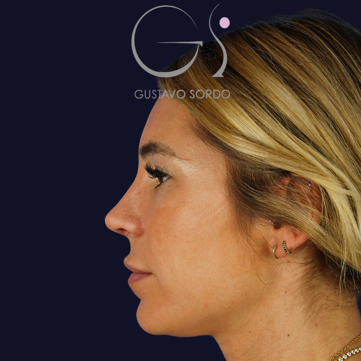Antes y después rinoplastia secundaria mujer joven