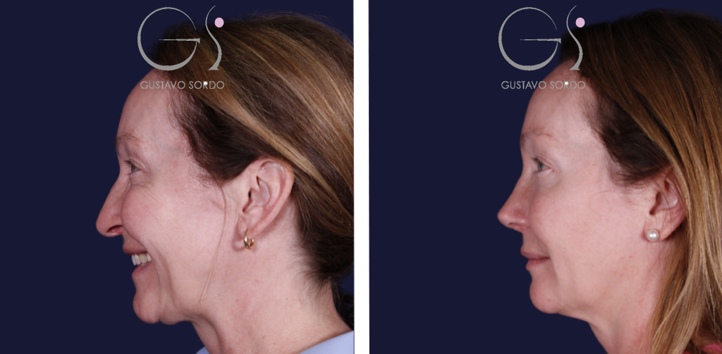 18 Types of Noses — Dr. Gustavo Sordo, plastic surgeon in Madrid (3)