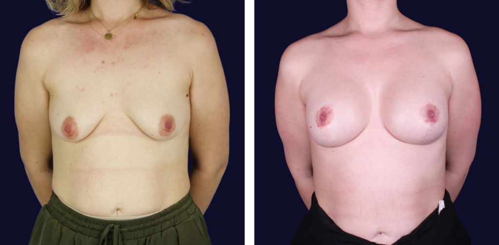 Tipos de mastopexia según la forma del pecho — antes y después — Dr. Gustavo Sordo, cirujano plástico en Madrid (2)