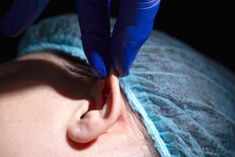 Otoplastia en Madrid