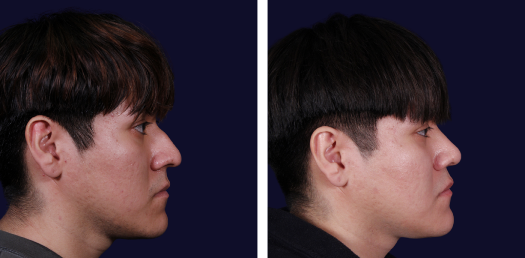 Rinoplastia masculina antes y después — Dr. Gustavo Sordo