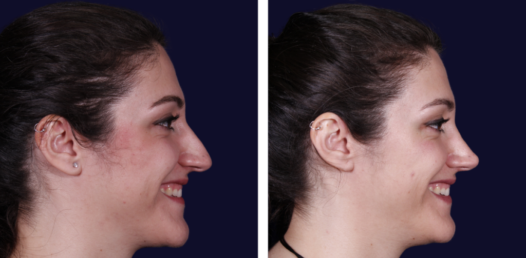 Rinoplastia — Dr. Gustavo Sordo, cirujano plástico en Madrid (3)