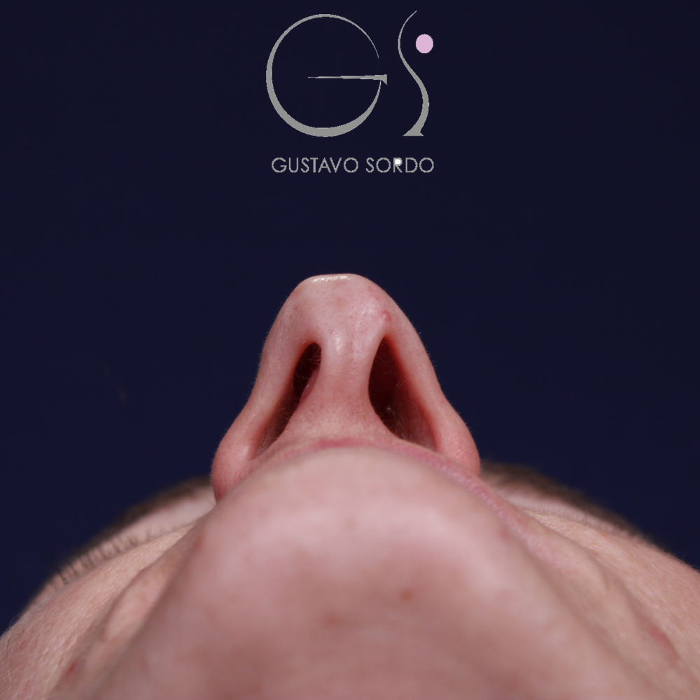 Rinoplastia, antes de la cirugía — caso operado por el Dr. Gustavo Sordo en Madrid (5)