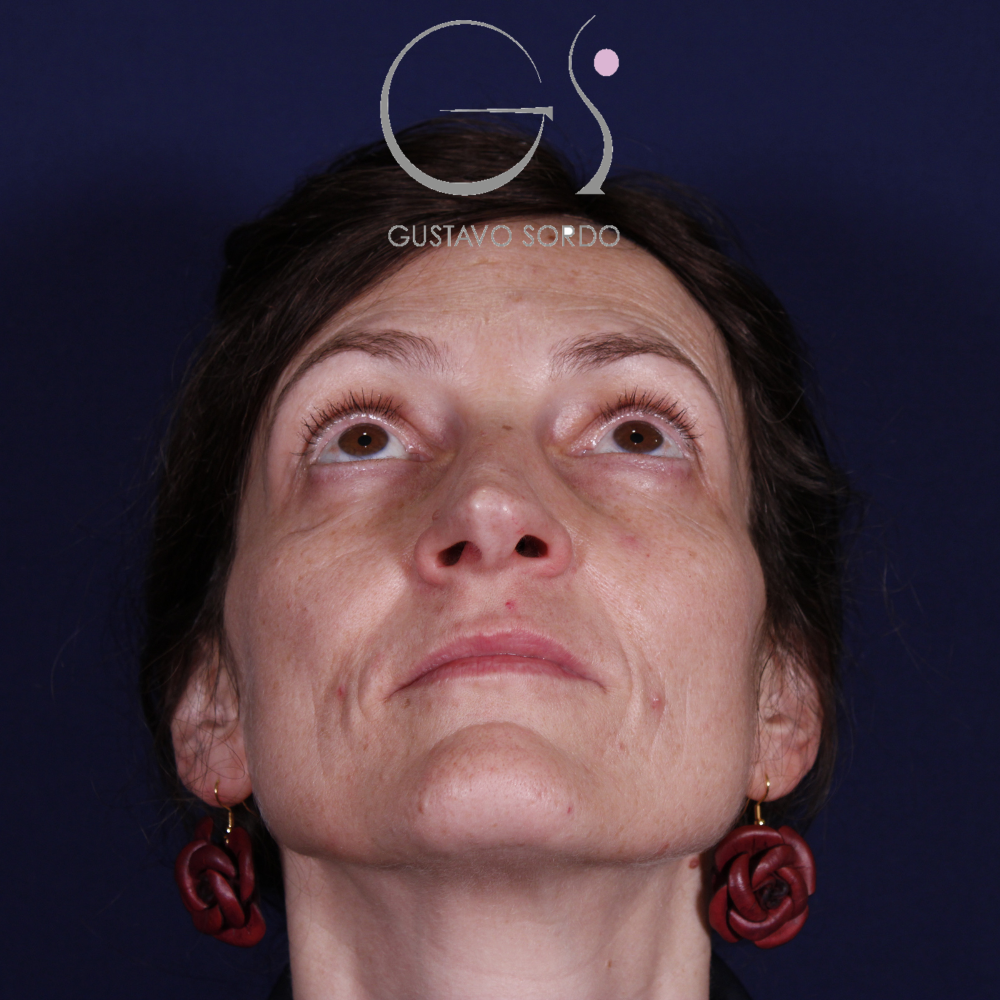 Rinoplastia, antes de la cirugía — caso operado por el Dr. Gustavo Sordo en Madrid (2)