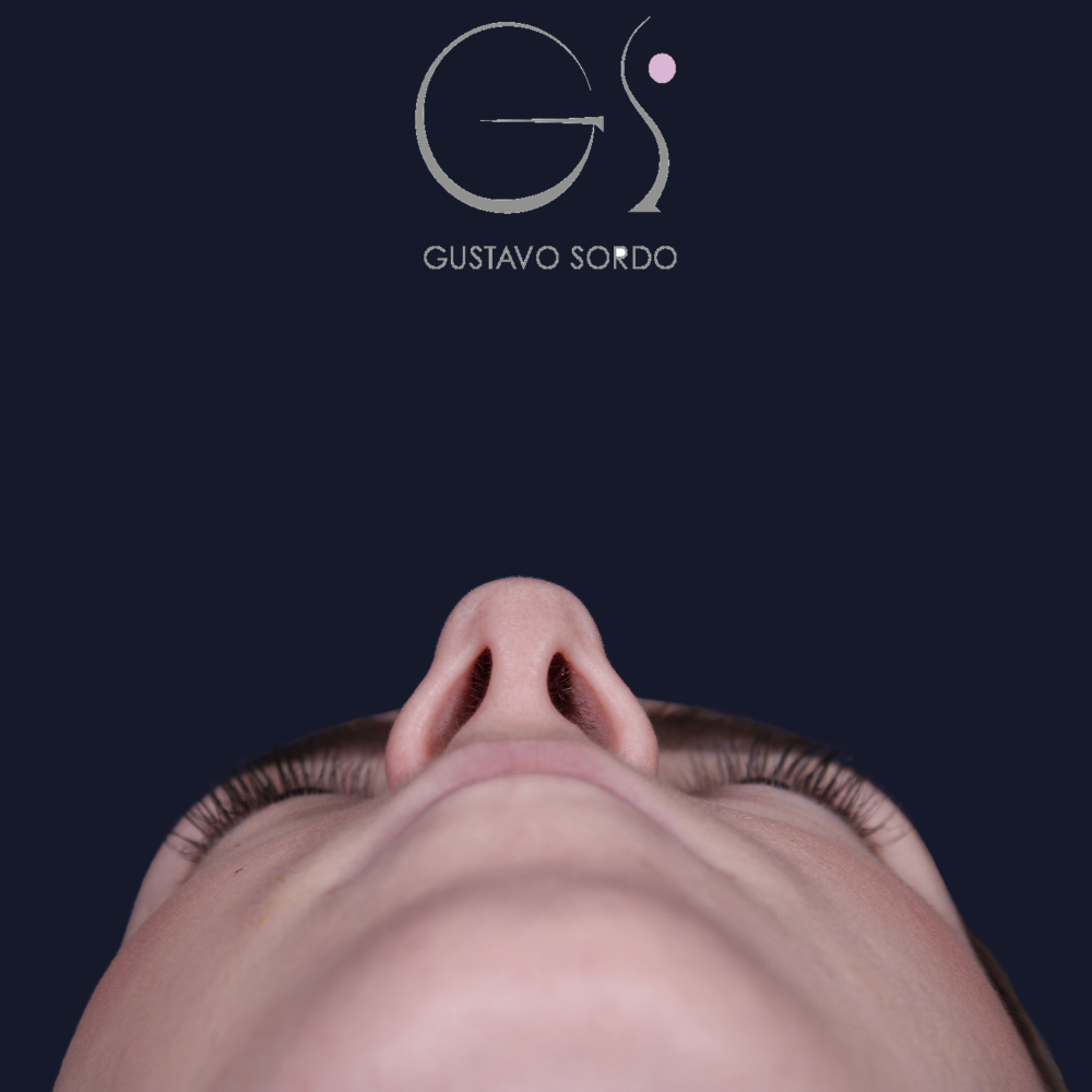 Rinoplastia, antes de la cirugía — caso operado por el Dr. Gustavo Sordo en Madrid (6)