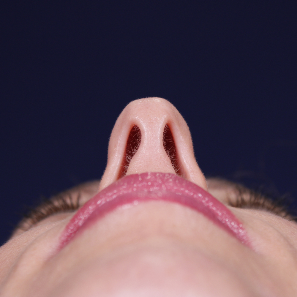 Rinoplastia, antes de la cirugía — caso operado por el Dr. Gustavo Sordo en Madrid (5)