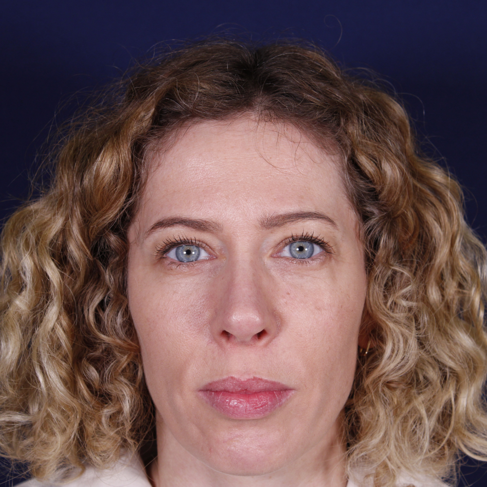 Rinoplastia, resultado tras la cirugía — caso operado por el Dr. Gustavo Sordo en Madrid (1)