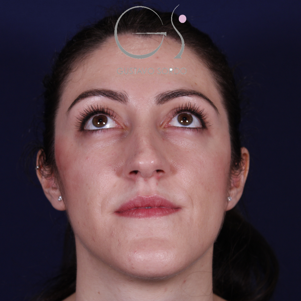 Antes de la rinoplastia con caballete y reducción de alas, vista frontal con el mentón arriba
