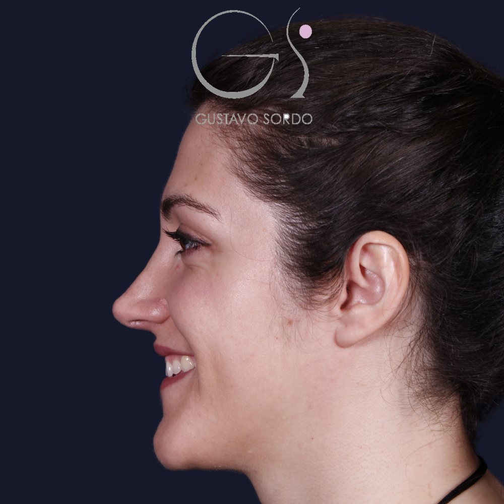 Después de la rinoplastia con caballete y reducción de alas, al año, vista de perfil izquierdo sonriendo