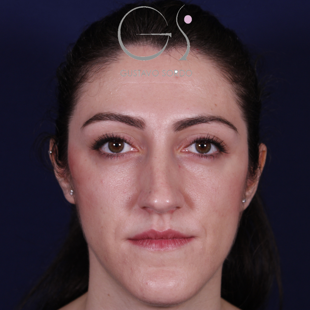 Antes de la rinoplastia con caballete y reducción de alas, vista frontal