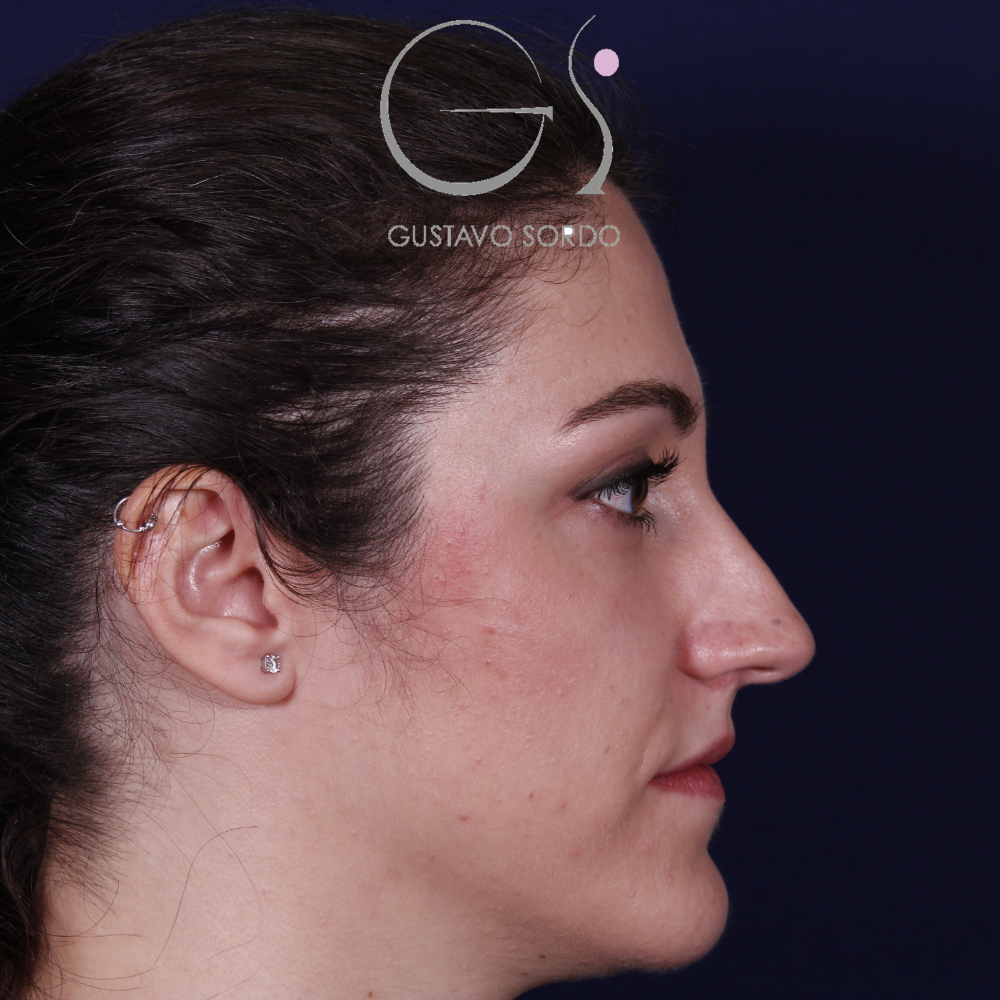 Antes de la rinoplastia con caballete y reducción de alas, vista de perfil derecho