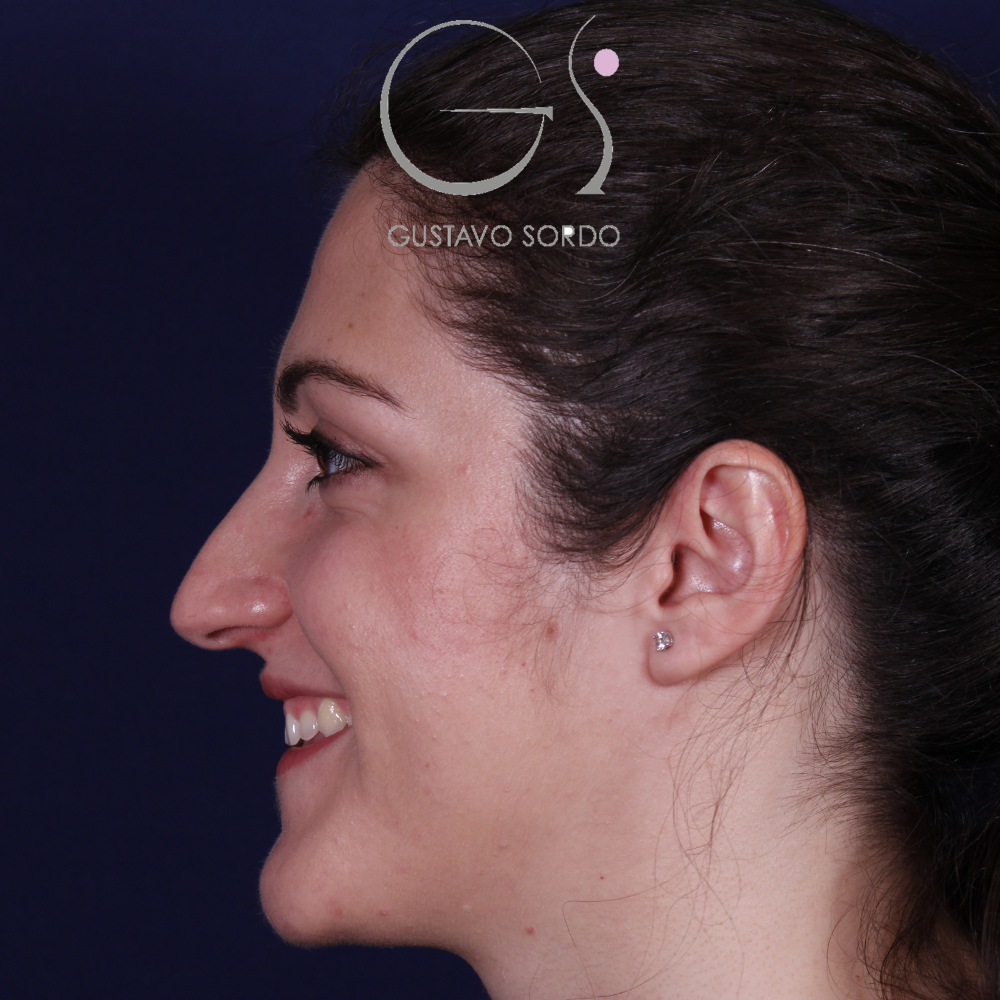 Antes de la rinoplastia con caballete y reducción de alas, vista de perfil izquierdo sonriendo