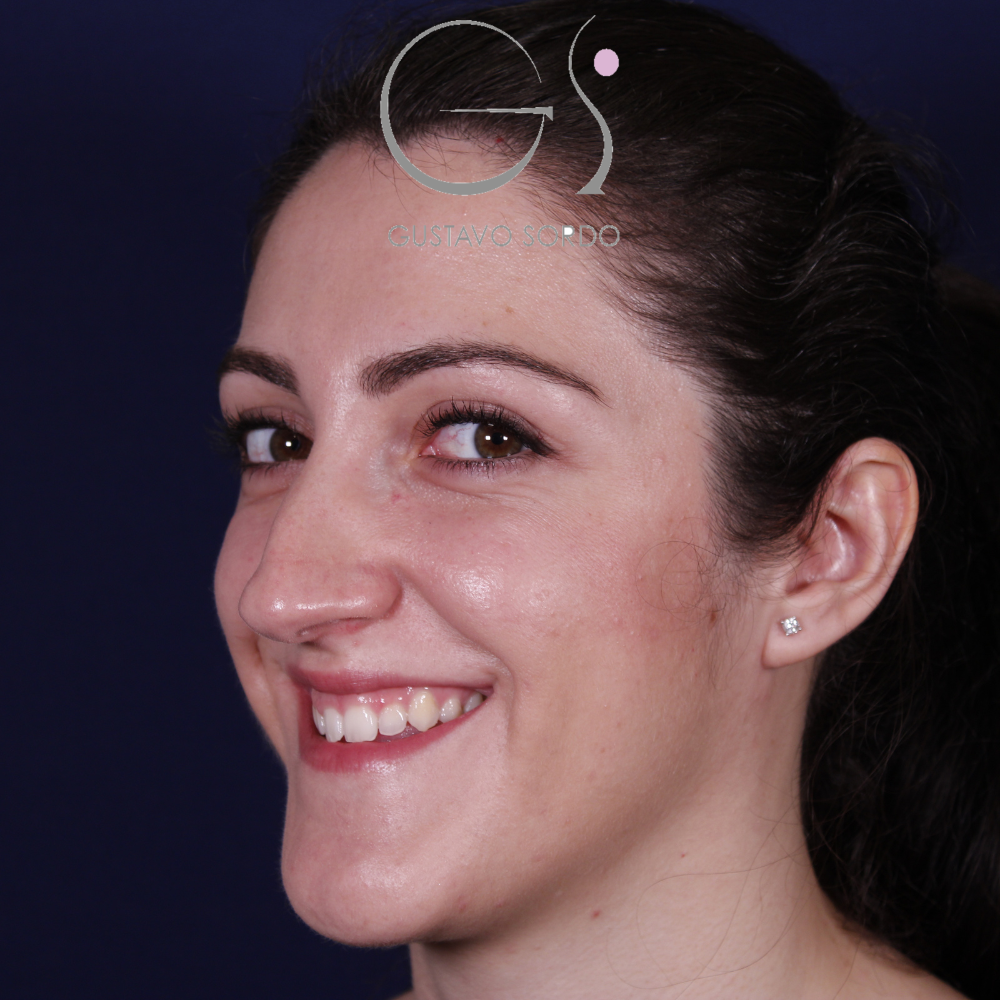 Antes de la rinoplastia con caballete y reducción de alas, vista de semiperfil izquierdo sonriendo