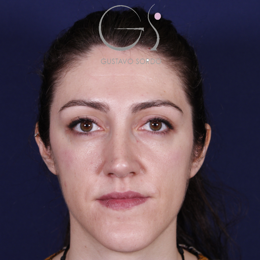 Después de la rinoplastia con caballete y reducción de alas, al año, vista frontal