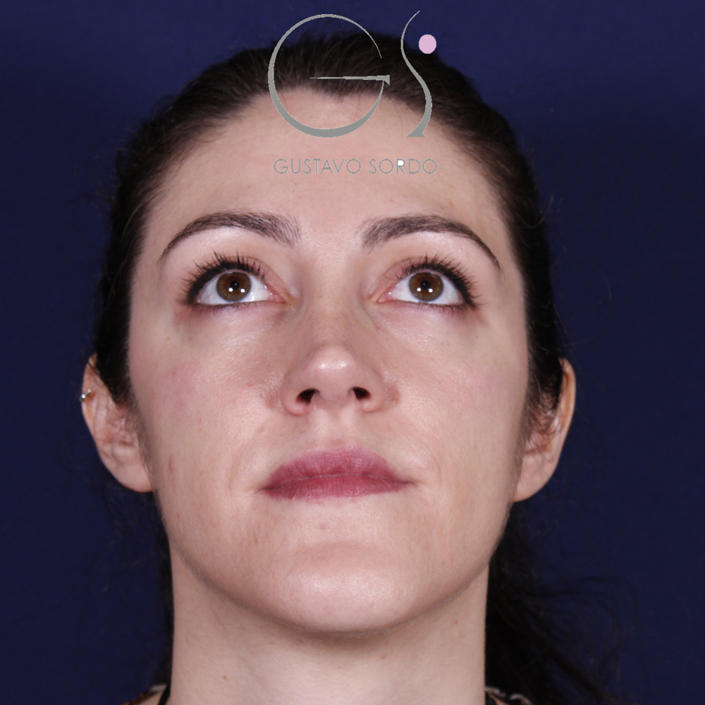 Después de la rinoplastia con caballete y reducción de alas, al año, vista frontal con el mentón arriba