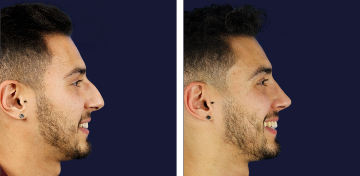 Rinoplastia De Famosos Masculinos Antes Y Después Celebrity Plastic