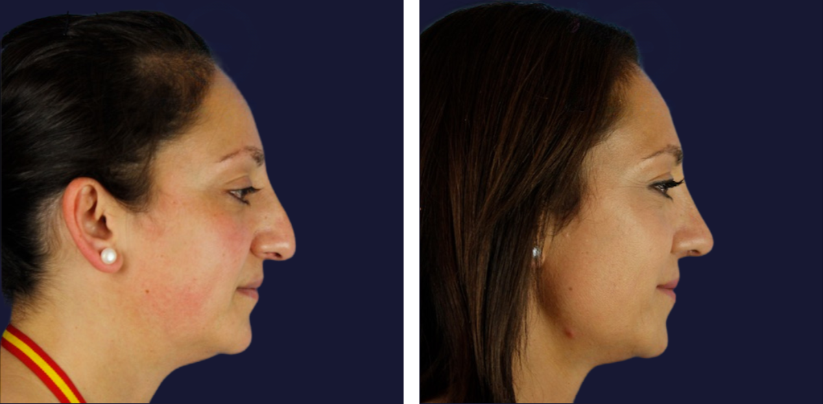 transformacion-tras-rinoplastia-ultrasonica