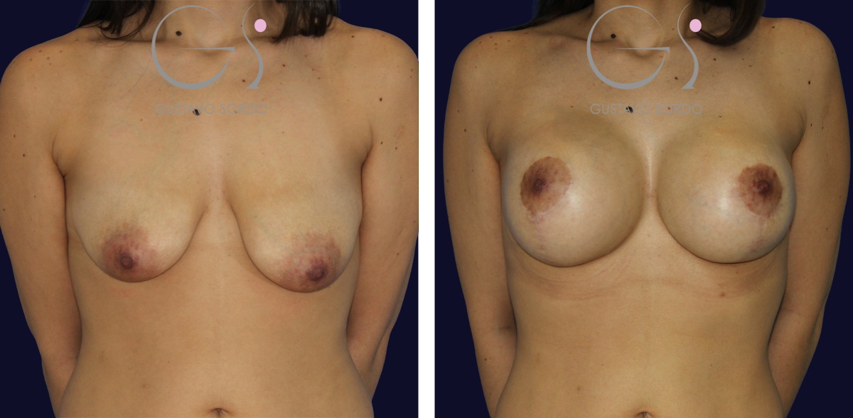 Mastopexia: antes e depois de um caso operado pelo Dr. Gustavo Sordo em Madrid.