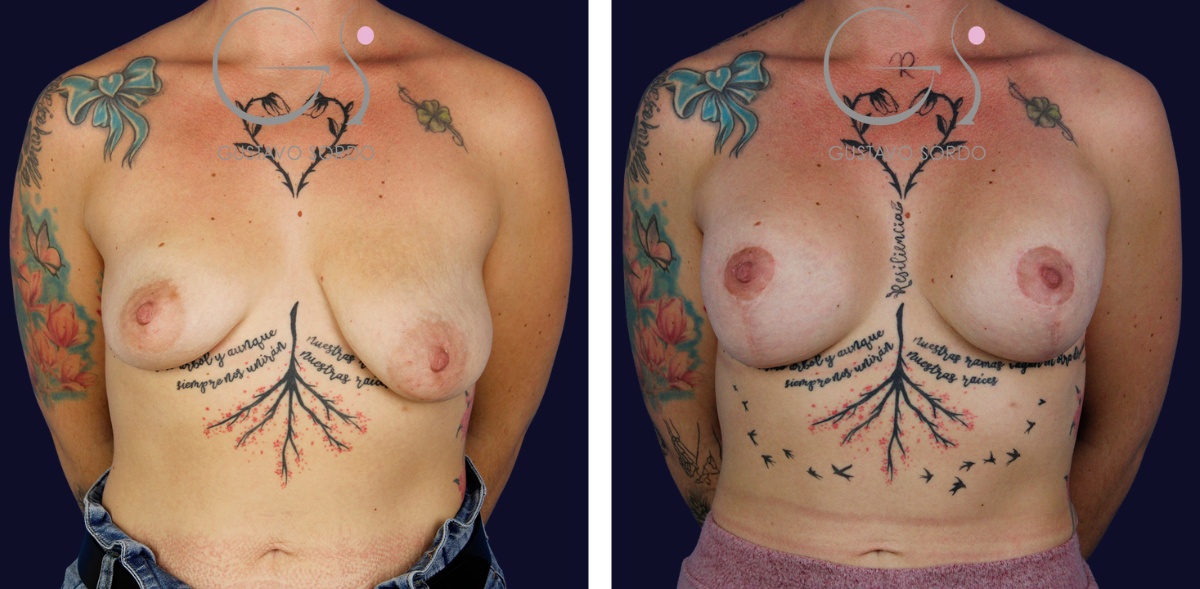 Mastopexia: antes e depois de um caso operado pelo Dr. Gustavo Sordo em Madrid.