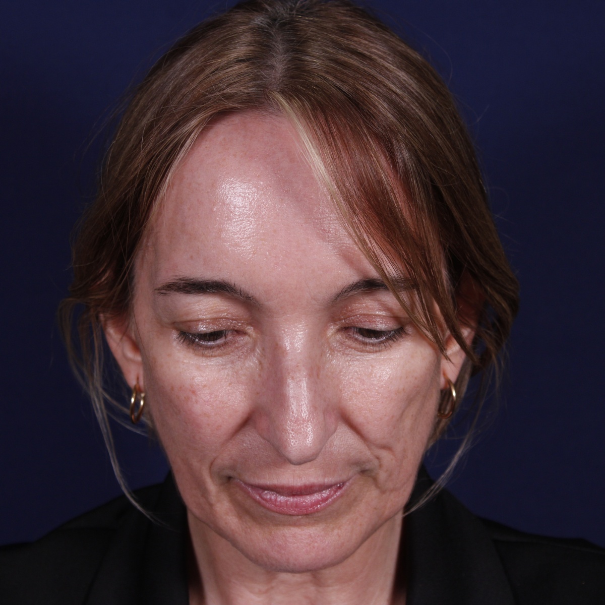 Rinoplastia, antes de la cirugía — caso operado por el Dr. Gustavo Sordo en Madrid (3)