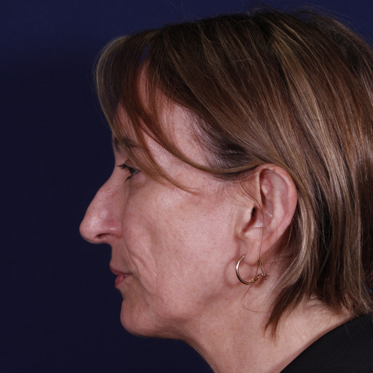 Rinoplastia, antes de la cirugía — caso operado por el Dr. Gustavo Sordo en Madrid (5)