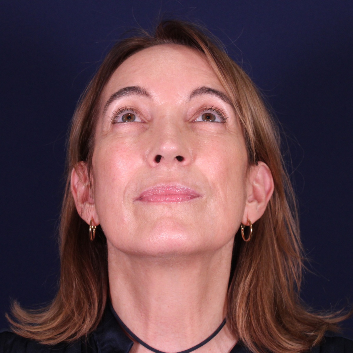 Rinoplastia, resultado tras la cirugía — caso operado por el Dr. Gustavo Sordo en Madrid (2)