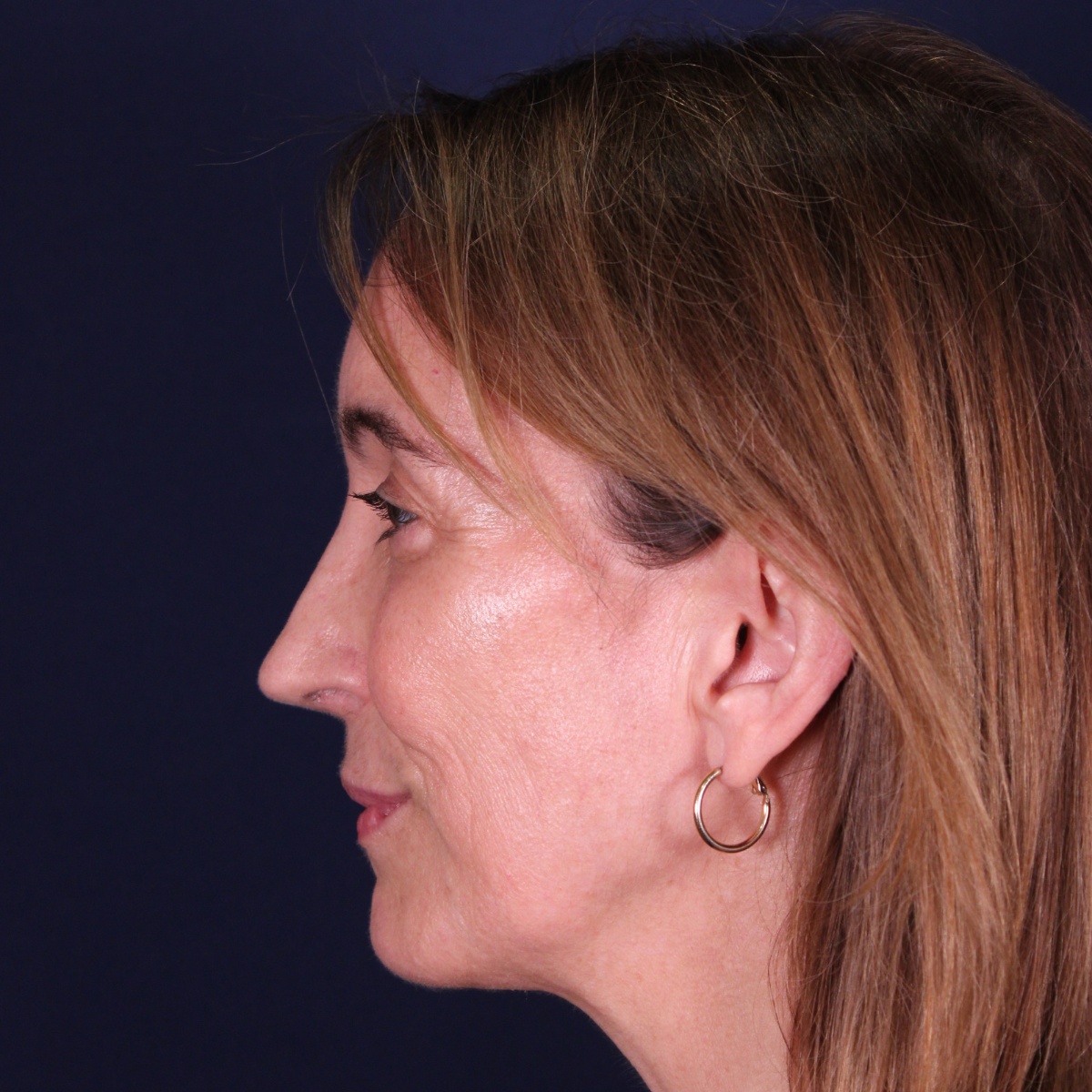 Rinoplastia, resultado tras la cirugía — caso operado por el Dr. Gustavo Sordo en Madrid (5)