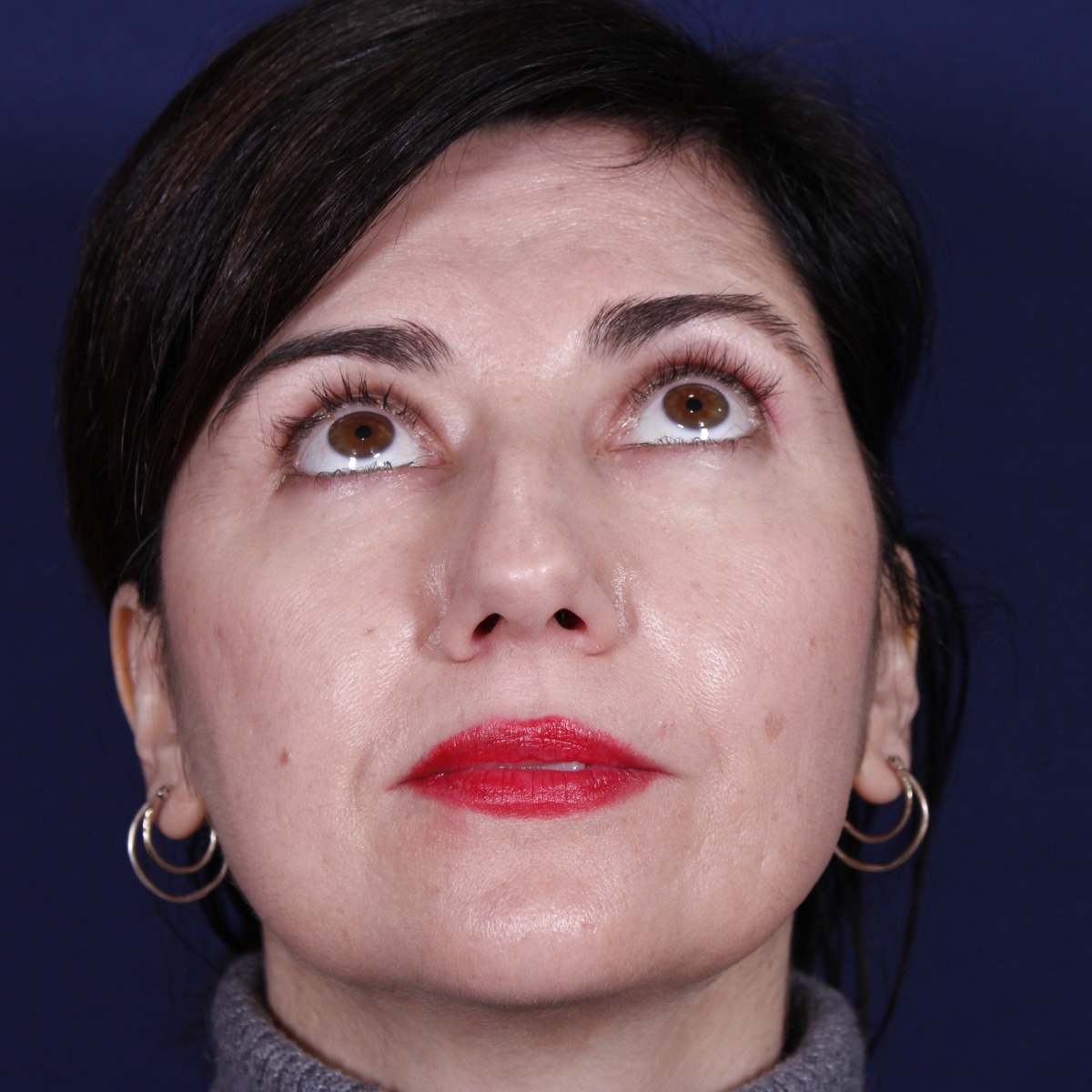Rinoplastia: antes y después de un caso operado por el Dr. Gustavo Sordo en Madrid