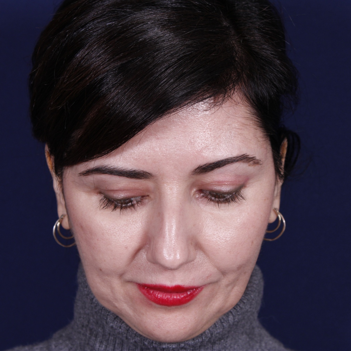 Rinoplastia: antes y después de un caso operado por el Dr. Gustavo Sordo en Madrid