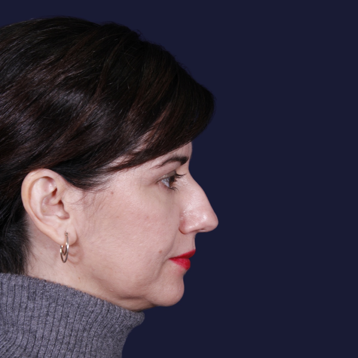 Rinoplastia: antes y después de un caso operado por el Dr. Gustavo Sordo en Madrid