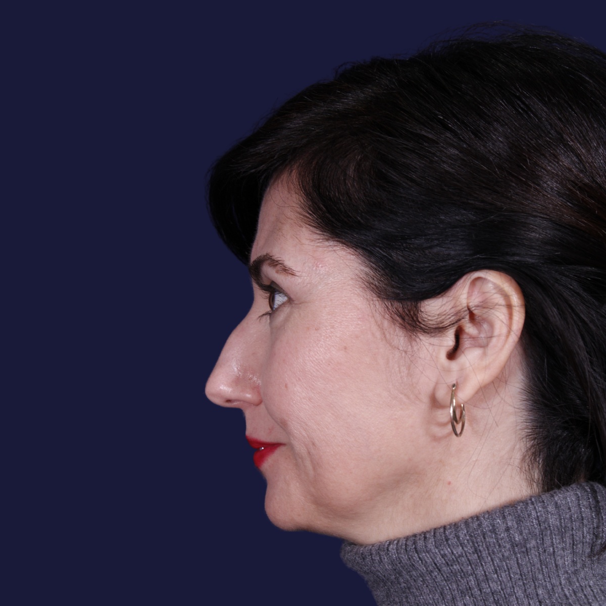 Rinoplastia: antes y después de un caso operado por el Dr. Gustavo Sordo en Madrid