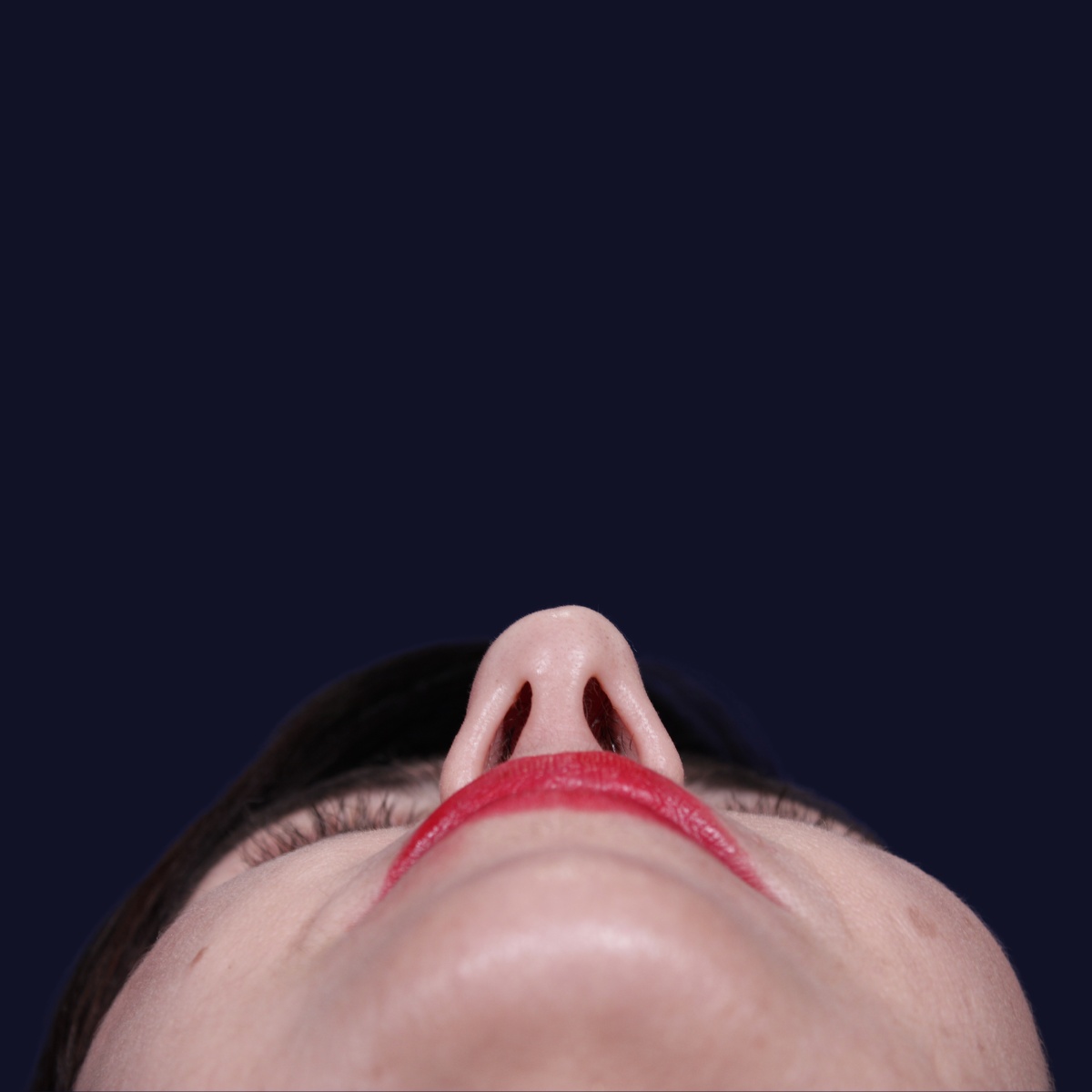 Rinoplastia: antes y después de un caso operado por el Dr. Gustavo Sordo en Madrid