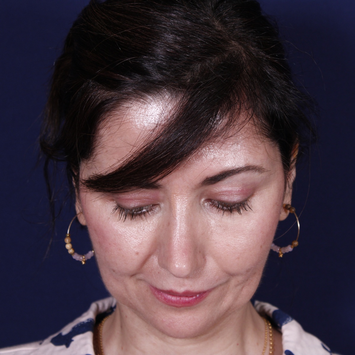 Rinoplastia: antes y después de un caso operado por el Dr. Gustavo Sordo en Madrid