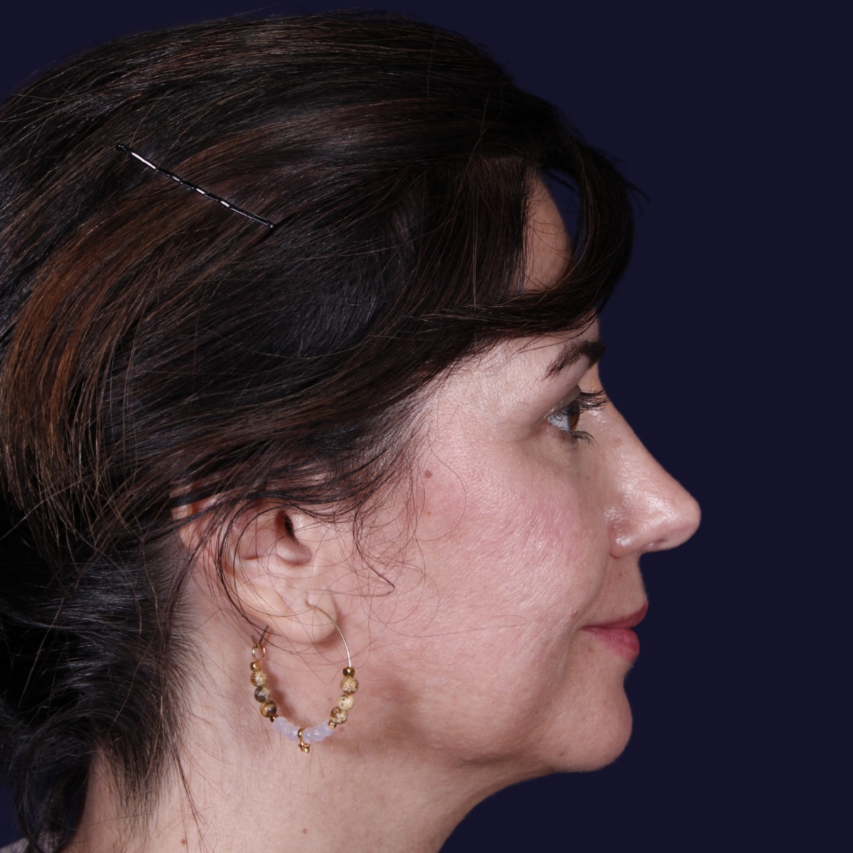 Rinoplastia: antes y después de un caso operado por el Dr. Gustavo Sordo en Madrid