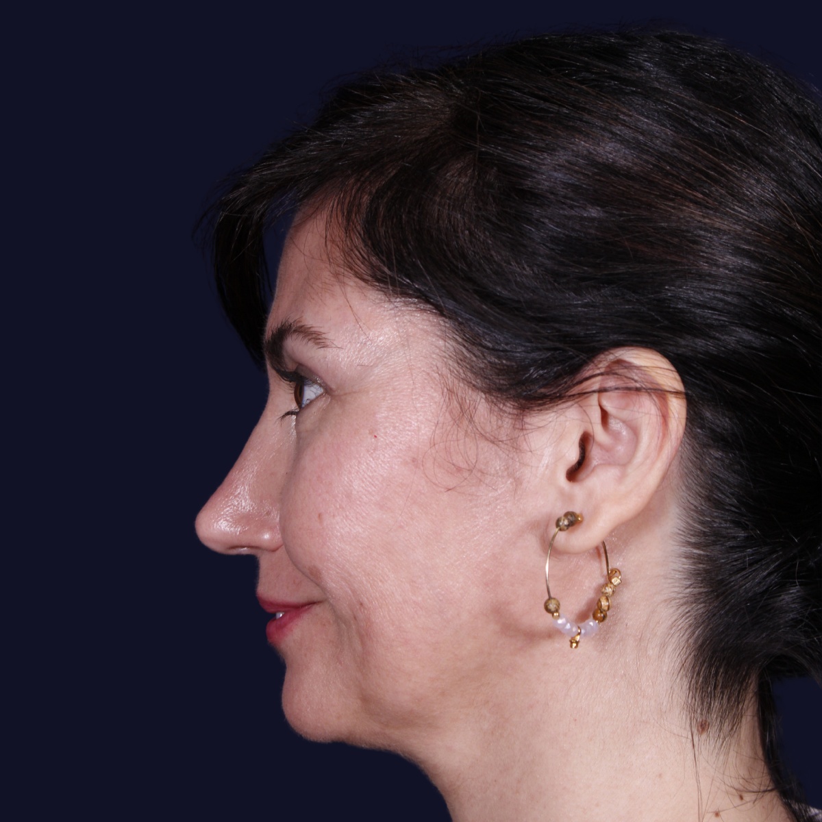 Rinoplastia: antes y después de un caso operado por el Dr. Gustavo Sordo en Madrid