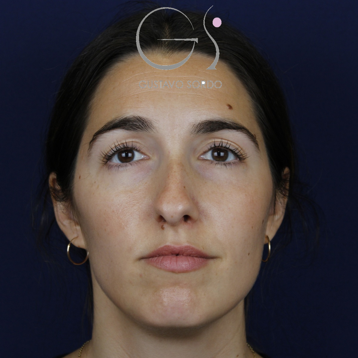 Rinoplastia, antes de la cirugía — caso operado por el Dr. Gustavo Sordo en Madrid (1)