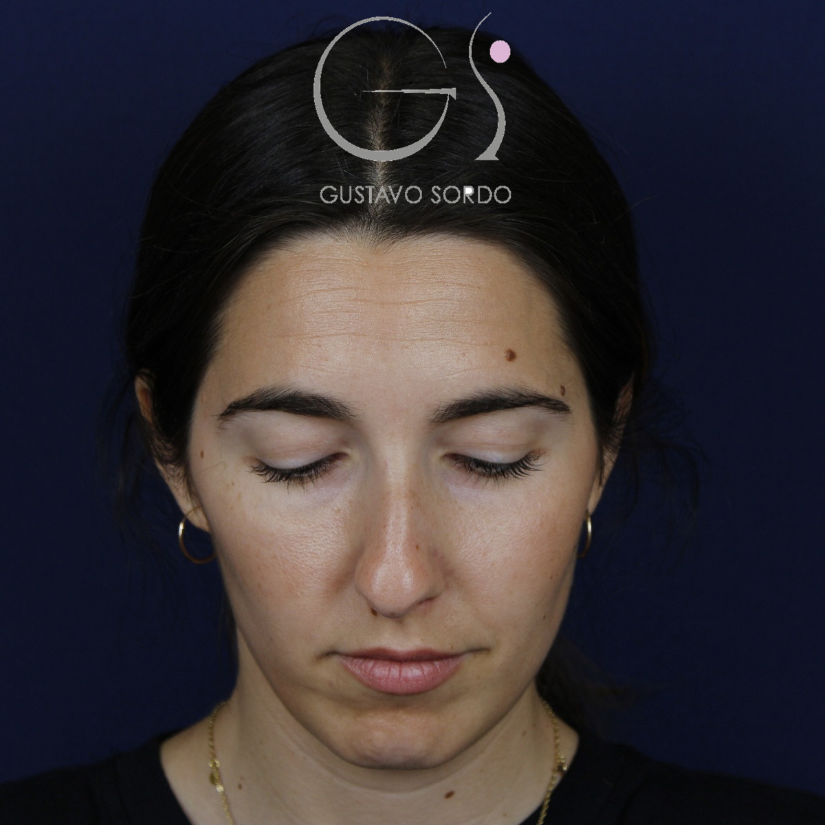 Rinoplastia, antes de la cirugía — caso operado por el Dr. Gustavo Sordo en Madrid (3)