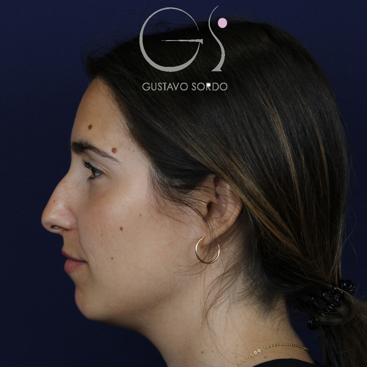 Rinoplastia, antes de la cirugía — caso operado por el Dr. Gustavo Sordo en Madrid (4)