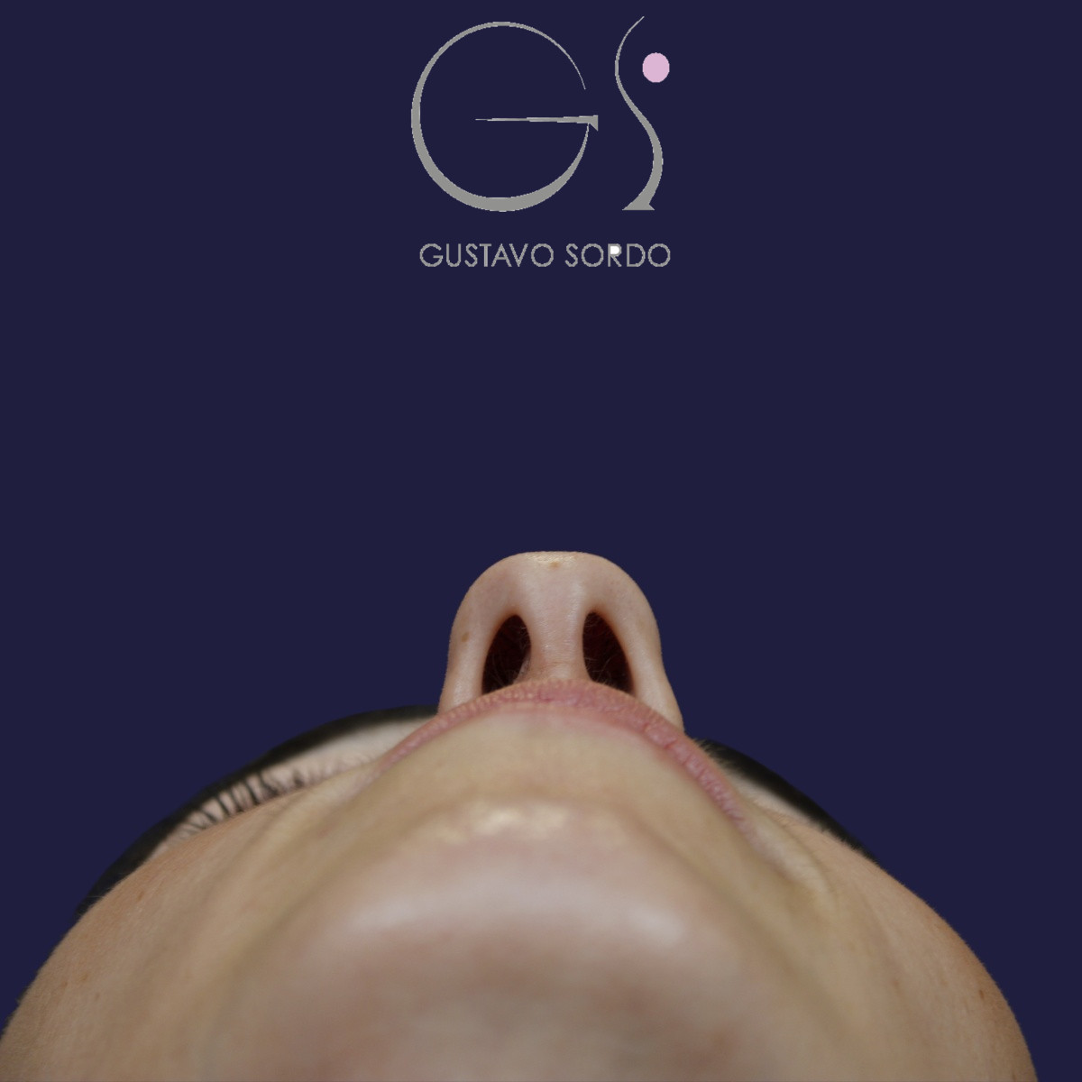 Rinoplastia, antes de la cirugía — caso operado por el Dr. Gustavo Sordo en Madrid (5)