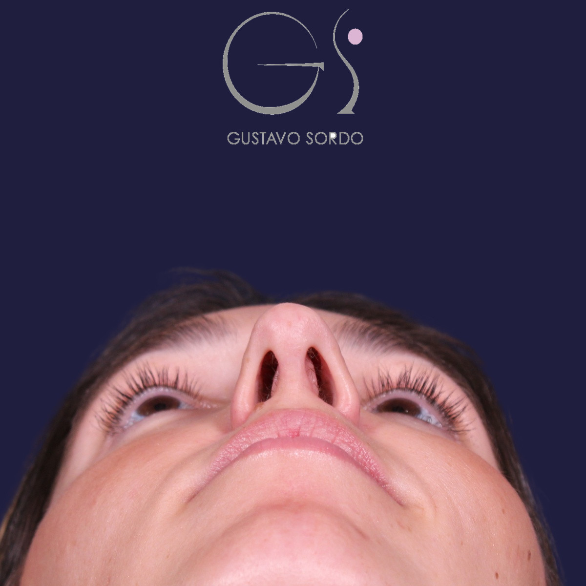 Rinoplastia, resultado tras la cirugía — caso operado por el Dr. Gustavo Sordo en Madrid (5)