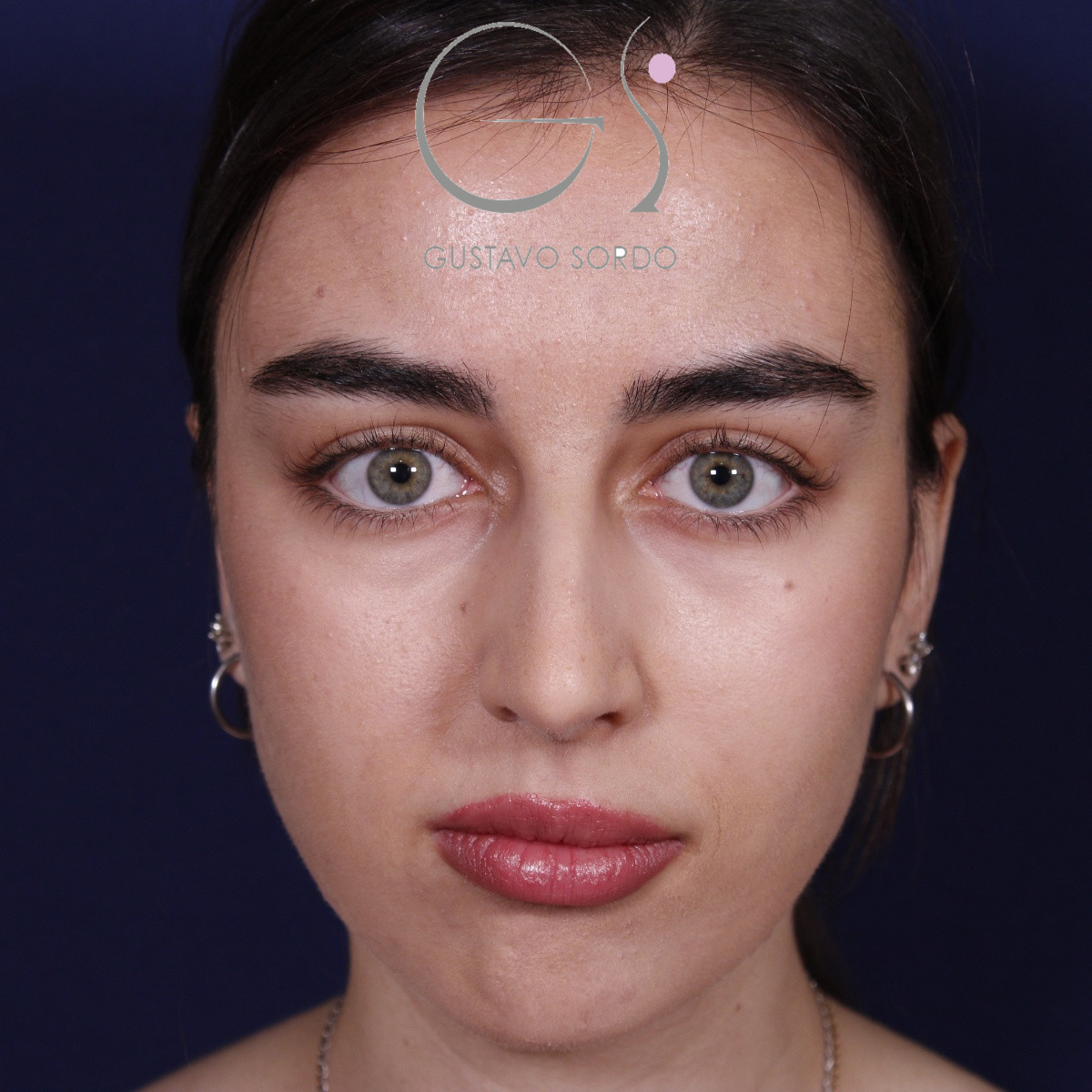 Rinoplastia ultrasónica combinada con mentoplastia — antes. Caso operado por el Dr. Gustavo Sordo en Madrid