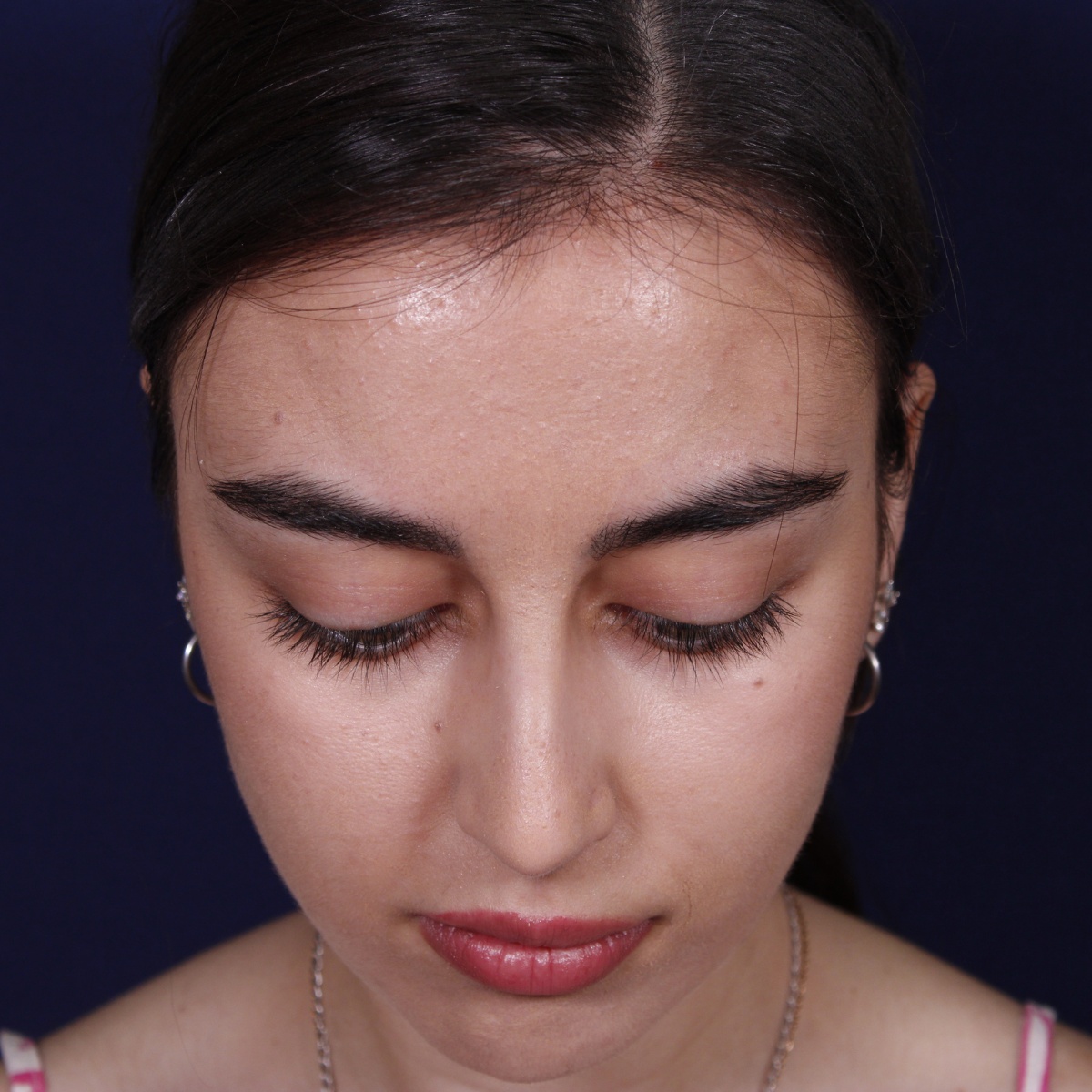 Rinoplastia ultrasónica combinada con mentoplastia — antes. Caso operado por el Dr. Gustavo Sordo en Madrid