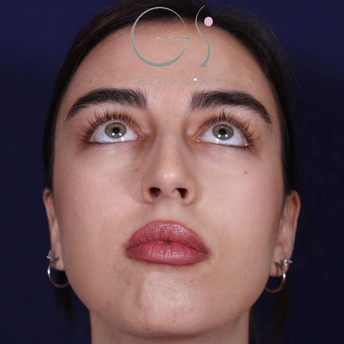 Rinoplastia ultrasónica combinada con mentoplastia — antes. Caso operado por el Dr. Gustavo Sordo en Madrid