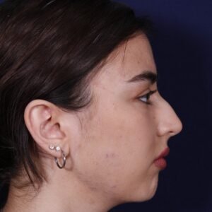 Rinoplastia: antes y después de un caso operado por el Dr. Gustavo Sordo en Madrid